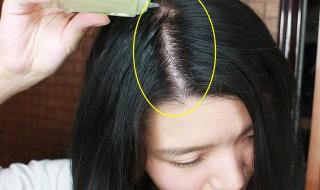 脱发掉发严重怎么办 脱发掉发严重怎么办