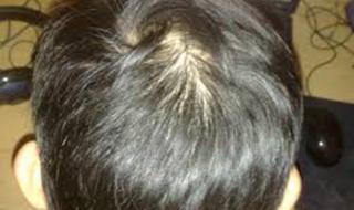 脱发掉发严重怎么办 脱发掉发严重怎么办