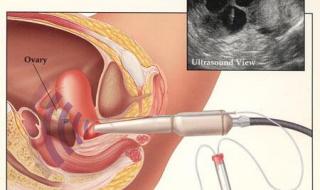 人工受精双胞胎费用 人工受精双胞胎费用
